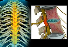 Thoracic Nerve Compression