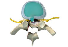 Thoracic Spine Decompression