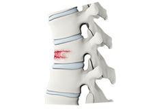 Thoracic Spine Fracture Repair Surgery
