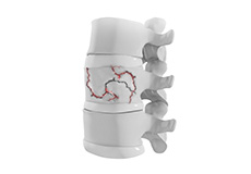 Thoracic Spine Trauma Surgery