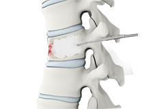 Thoracic Vertebroplasty