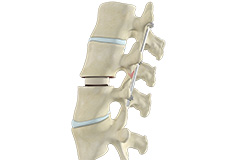 Transforaminal Lumbar Interbody Fusion (TLIF)