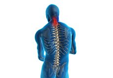 Traumatic Spinal Cord Injury